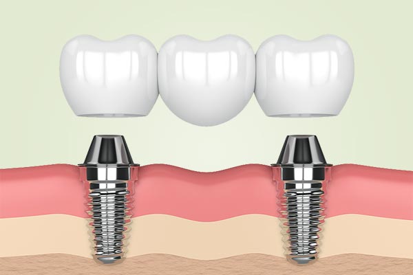 two dental implants and bridge
