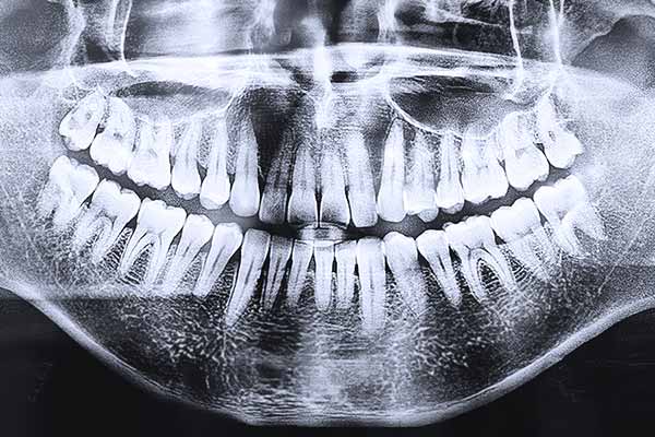 panoramic dental x ray