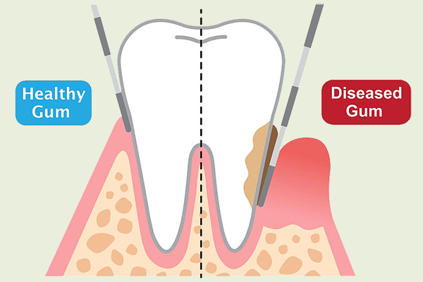 healthy teeth and gums compared to periodontal disease