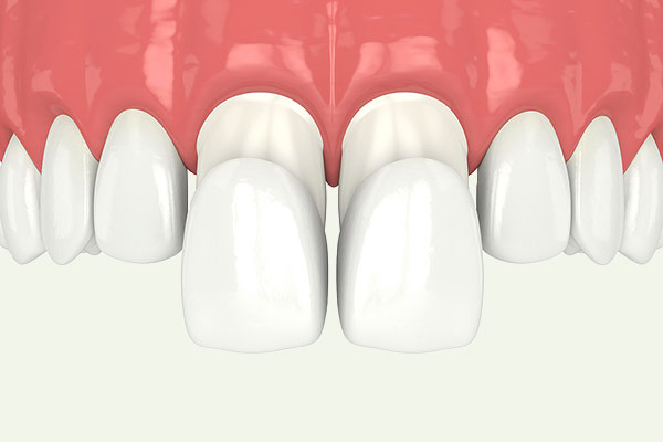 dental veneers