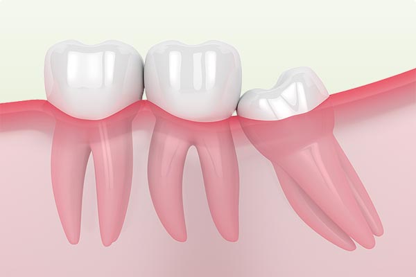 impacted wisdom tooth extraction